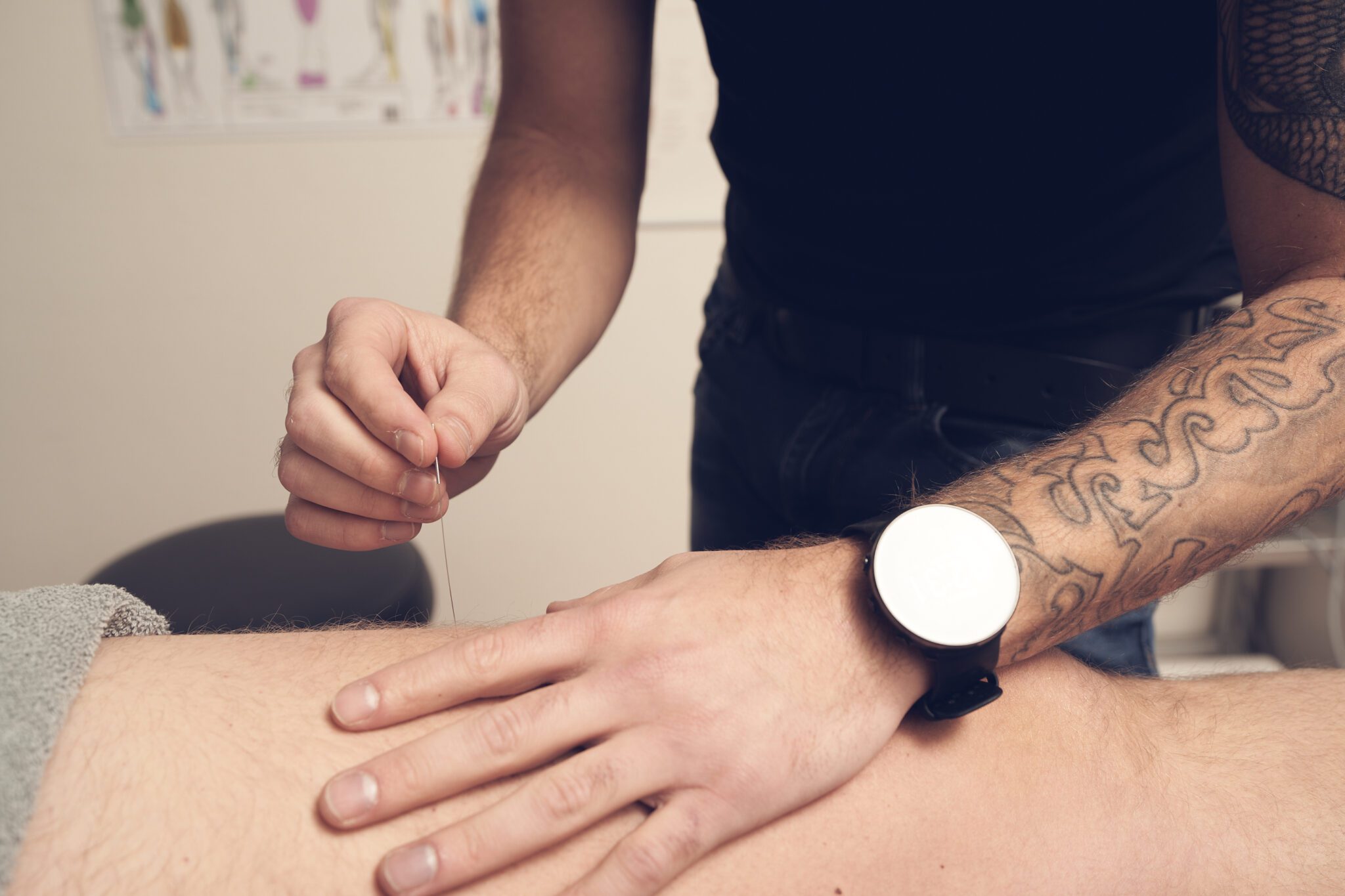 Dry needling behandeling bij Fysio in Motion