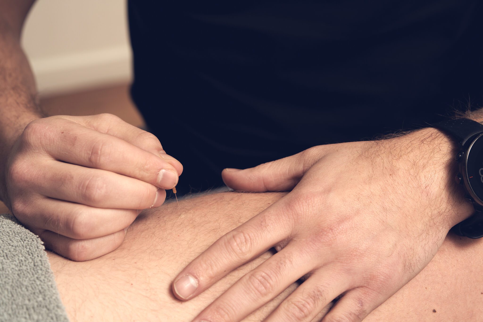 Dry needling in spier